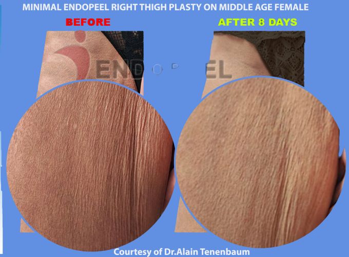zoom on female thighs plasty post lipoplasty