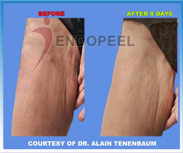 female thighs plasty post lipoplasty